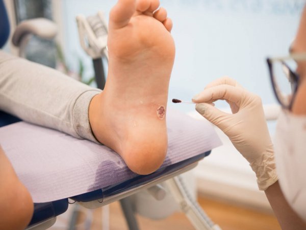 verruga plantar
